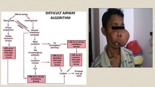 Main Airway Algorithm Maxillofacial surgery and anesthetic issues | PPTX