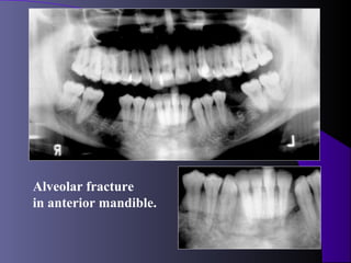 Alveolar fracture
in anterior mandible.
 