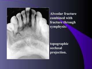 Alveolar fracture
combined with
fracture through
symphysis:



topographic
occlusal
projection.
 