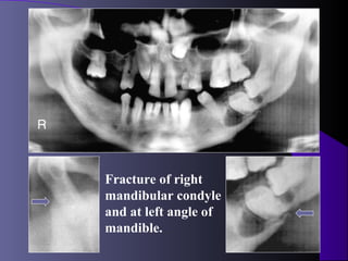 Fracture of right
mandibular condyle
and at left angle of
mandible.
 