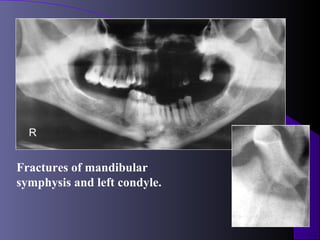 R


Fractures of mandibular
symphysis and left condyle.
 