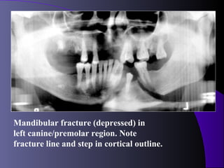 Mandibular fracture (depressed) in
left canine/premolar region. Note
fracture line and step in cortical outline.
 