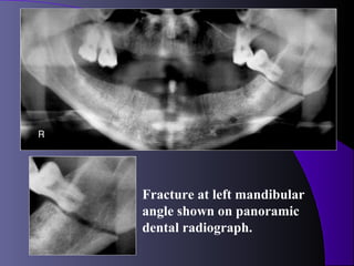 Fracture at left mandibular
angle shown on panoramic
dental radiograph.
 