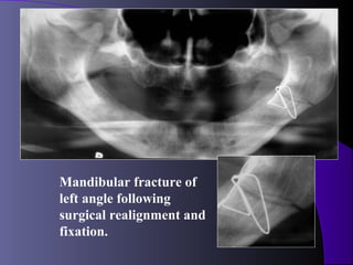 Mandibular fracture of
left angle following
surgical realignment and
fixation.
 