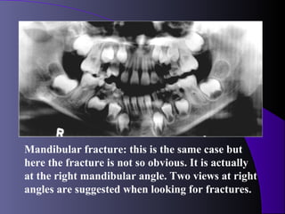 Mandibular fracture: this is the same case but
here the fracture is not so obvious. It is actually
at the right mandibular angle. Two views at right
angles are suggested when looking for fractures.
 