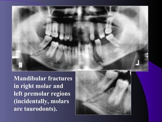 Mandibular fractures
in right molar and
left premolar regions
(incidentally, molars
are taurodonts).
 