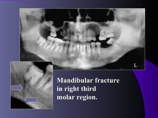 L

Mandibular fracture
in right third
molar region.
 