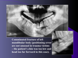 R

    Comminuted fracture of left
    mandibular body (positioning error
    are not unusual in trauma victims
    – the patient’s chin was too low and
    head too far forward in this case).
 