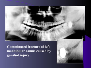 L


Comminuted fracture of left
mandibular ramus caused by
gunshot injury.
 