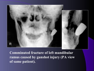 R

Comminuted fracture of left mandibular
ramus caused by gunshot injury (PA view
of same patient).
 