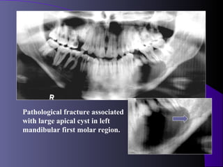 Pathological fracture associated
with large apical cyst in left
mandibular first molar region.
 