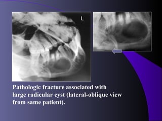 L




Pathologic fracture associated with
large radicular cyst (lateral-oblique view
from same patient).
 