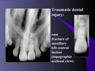 Traumatic dental
injury:



root
fracture of
maxillary
left central
incisor
(topographic
occlusal view).
 