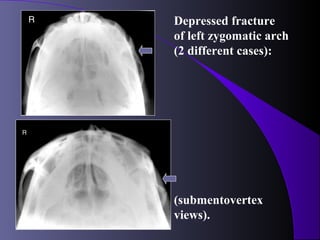 Depressed fracture
of left zygomatic arch
(2 different cases):




(submentovertex
views).
 