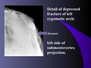 Detail of depressed
fracture of left
zygomatic arch:


fracture


left side of
submentovertex
projection.
 