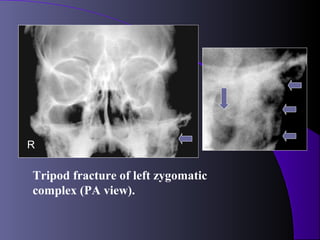 R

Tripod fracture of left zygomatic
complex (PA view).
 