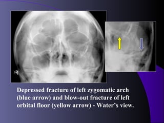 Depressed fracture of left zygomatic arch
(blue arrow) and blow-out fracture of left
orbital floor (yellow arrow) - Water’s view.
 