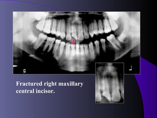 Fractured right maxillary
central incisor.
 