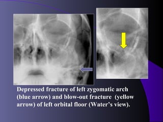 Depressed fracture of left zygomatic arch
(blue arrow) and blow-out fracture (yellow
arrow) of left orbital floor (Water’s view).
 