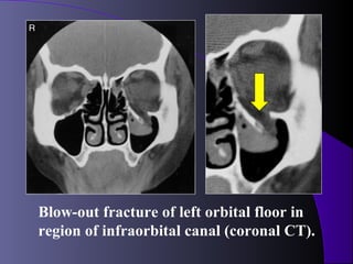 Blow-out fracture of left orbital floor in
region of infraorbital canal (coronal CT).
 