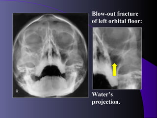 Blow-out fracture
of left orbital floor:




Water’s
projection.
 