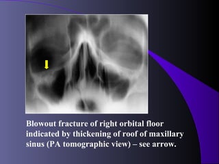 Blowout fracture of right orbital floor
indicated by thickening of roof of maxillary
sinus (PA tomographic view) – see arrow.
 