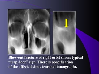 Blow-out fracture of right orbit shows typical
“trap door” sign. There is opacification
of the affected sinus (coronal tomograph).
 