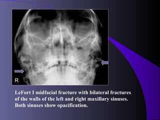 R

LeFort I midfacial fracture with bilateral fractures
of the walls of the left and right maxillary sinuses.
Both sinuses show opacification.
 
