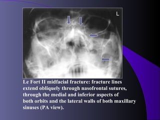 L




Le Fort II midfacial fracture: fracture lines
extend obliquely through nasofrontal sutures,
through the medial and inferior aspects of
both orbits and the lateral walls of both maxillary
sinuses (PA view).
 