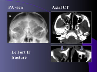 PA view          Axial CT

R




    Le Fort II
    fracture
 