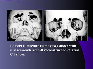 Le Fort II fracture (same case) shown with
surface-rendered 3-D reconstruction of axial
CT slices.
 