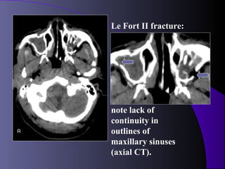 Le Fort II fracture:




note lack of
continuity in
outlines of
maxillary sinuses
(axial CT).
 