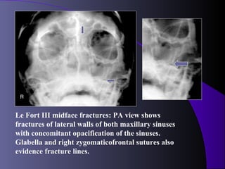 Le Fort III midface fractures: PA view shows
fractures of lateral walls of both maxillary sinuses
with concomitant opacification of the sinuses.
Glabella and right zygomaticofrontal sutures also
evidence fracture lines.
 