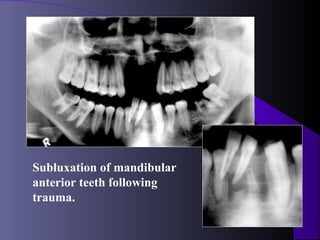 Subluxation of mandibular
anterior teeth following
trauma.
 