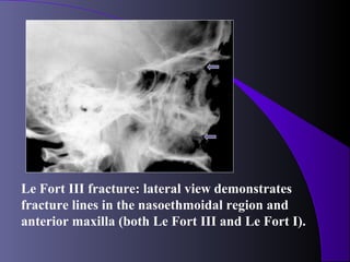 Le Fort III fracture: lateral view demonstrates
fracture lines in the nasoethmoidal region and
anterior maxilla (both Le Fort III and Le Fort I).
 