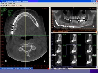 R     L




        BUC   LING


R   L
 