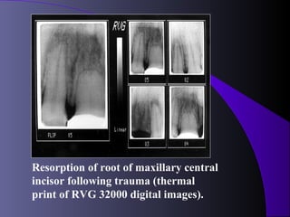 Resorption of root of maxillary central
incisor following trauma (thermal
print of RVG 32000 digital images).
 