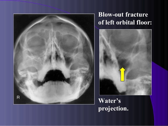 Maxillofacial fractures