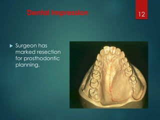 Dental Impression 
 Surgeon has 
marked resection 
for prosthodontic 
planning. 
12 
 