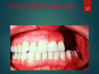 Premaxilla Preserved 37 
 