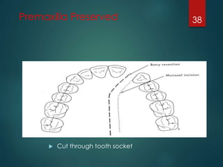 Premaxilla Preserved 
 Cut through tooth socket 
38 
 