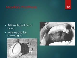 Maxillary Prosthesis 
 Articulates with scar 
band. 
 Hollowed to be 
lightweight. 
42 
 