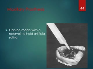 Maxillary Prosthesis 
 Can be made with a 
reservoir to hold artificial 
saliva. 
44 
 