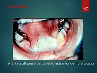 Mandible 
47 
 Skin graft preserves alveolar ridge for denture support 
 