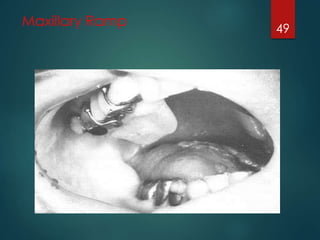 Maxillary Ramp 
49 
 