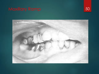Maxillary Ramp 50 
 