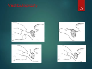 Vestibuloplasty 
52 
 