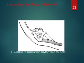 Lowering the Floor of Mouth 
 Goal is to reposition mylohyoid muscle. 
53 
 