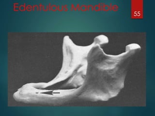 Edentulous Mandible 
55 
 
