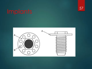 Implants 
57 
 